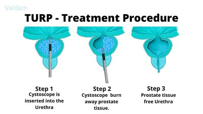 The treatment procedure for TURP.
