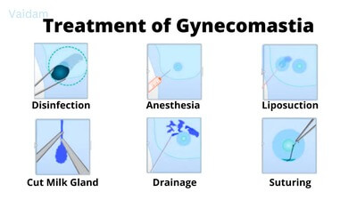 Treatment of Gynecomastia.