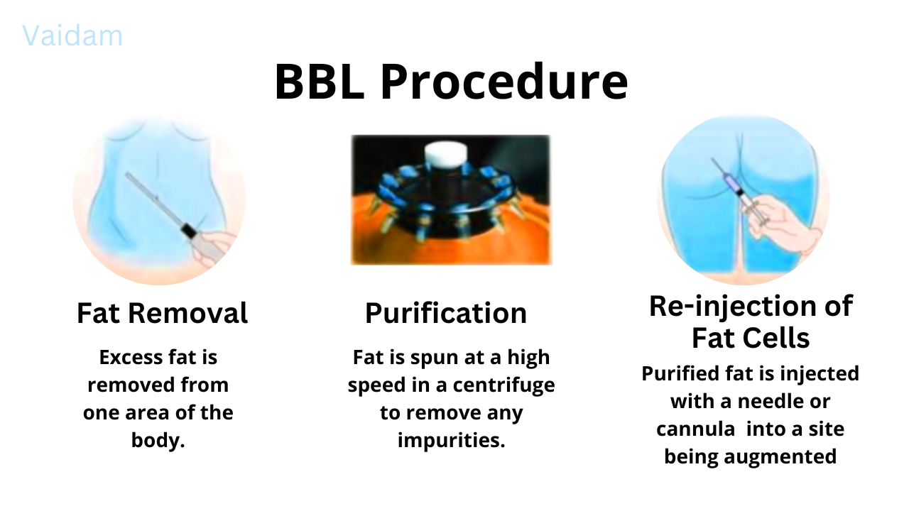 The procedure of Brazilain Butt Lift.
