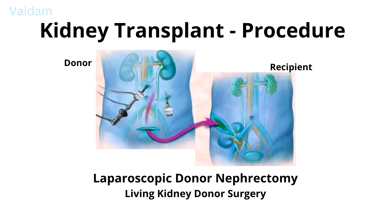 Procedure for Kidney Transplant.