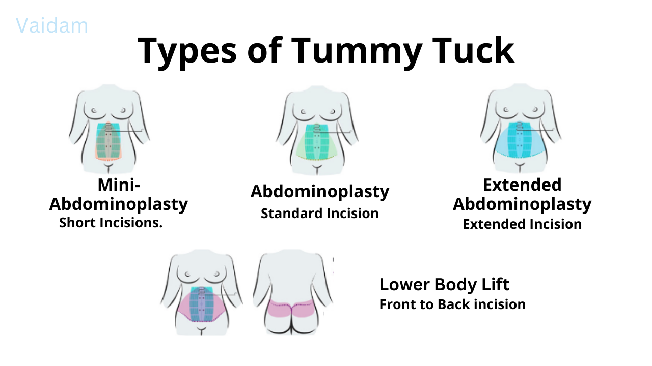 Types of Abdominoplasty.