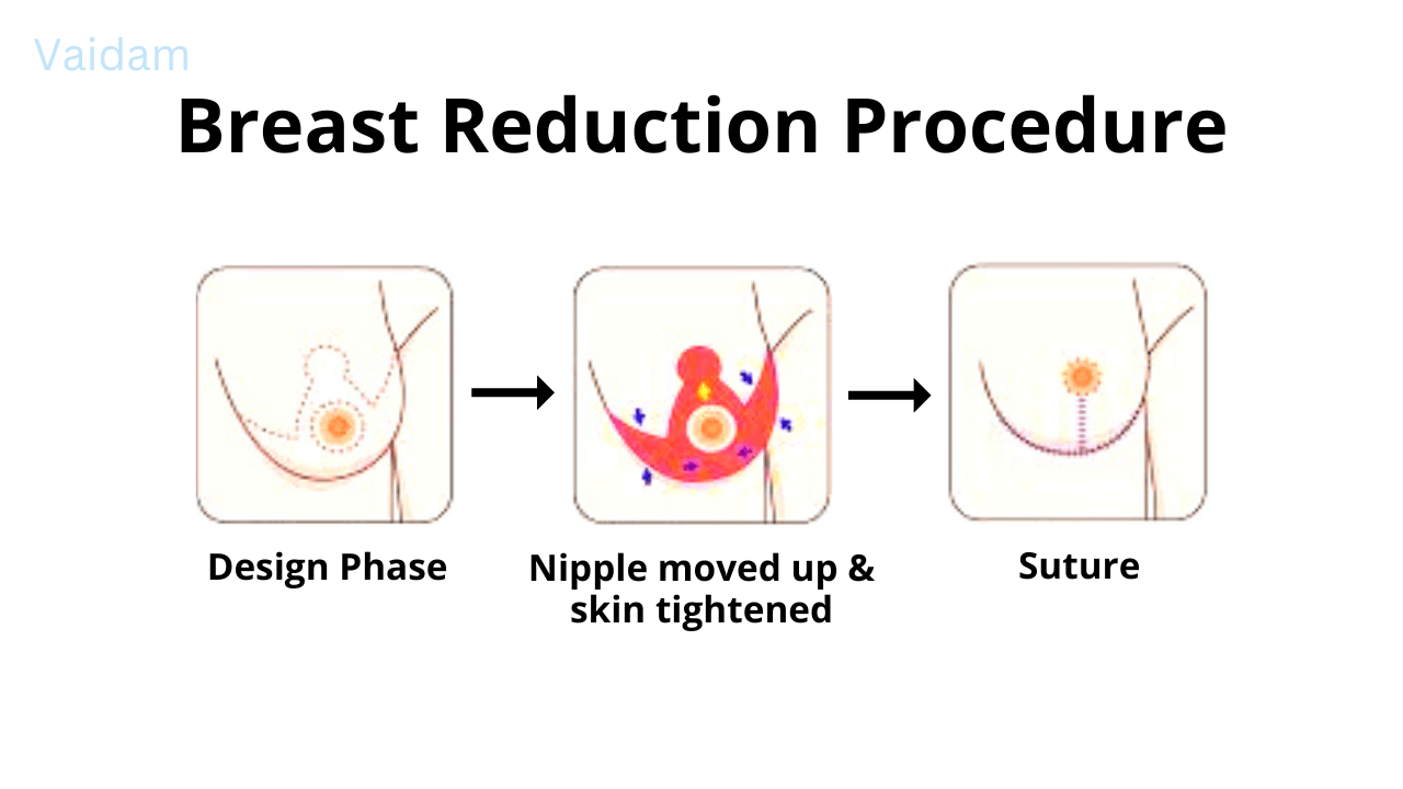 Procedure in Breast Reduction surgery.