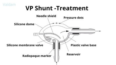 Treatment for VP shunt.