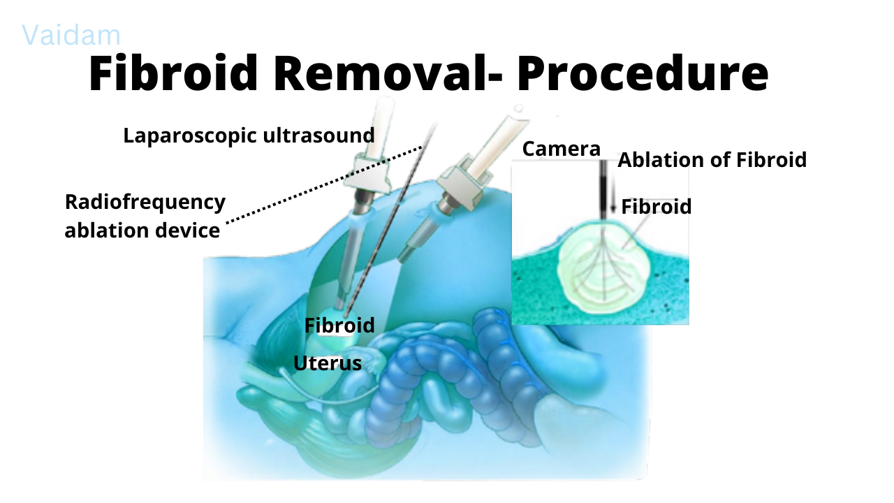 The procedure of Fibroid Removal Surgery.