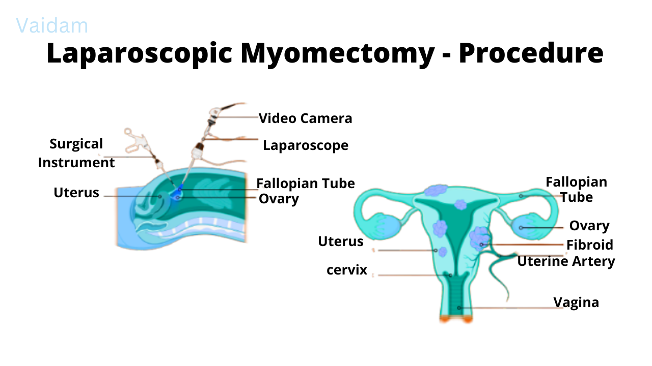 Procedure for Laparoscopic Myomectomy.